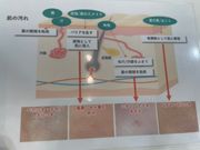 今回受けた背術の内容です